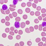 Descubierto un gen causante de la leucemia linfocítica crónica