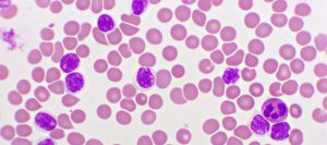 Descubierto un gen causante de la leucemia linfocítica crónica