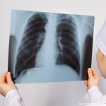 A doctor examines an X-ray of the lungs of a patient with pneumonia. Pulmonology and radiology, lung disease