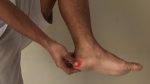Fascitis plantar: una dolencia cada vez más frecuente