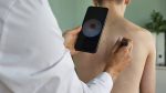 La inteligencia artificial ya detecta el melanoma con gran precisión